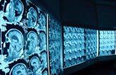 Foto: Detectan alteraciones de la corteza cerebral en pacientes con enfermedad de Parkinson recién diagnosticados