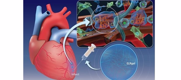 La inyección de un hidrogel puede promover la curación del músculo cardíaco después de un infarto.