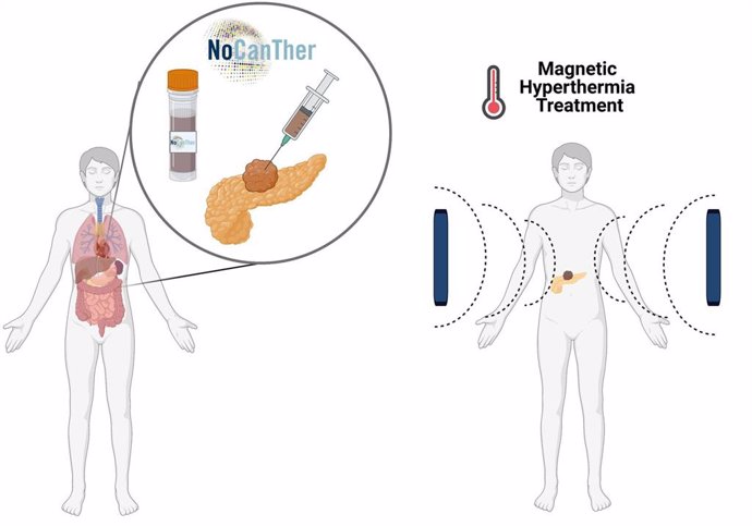 El estudio entra en su última fase para el tratamiento del cáncer de páncreas localmente avanzado mediante el uso de nanopartículas magnéticas