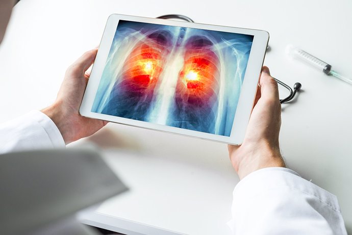 Archivo - Radiografía digital acerca de un cáncer de pulmón