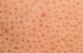 Foto: Claves sobre la ictiosis, una enfermedad genética caracterizada por una intensa sequedad en la piel