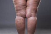 Foto: El lipedema, una enfermedad aún desconocida que implica un acúmulo de grasa patológico en brazos y piernas