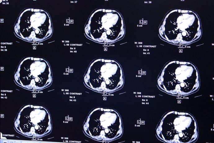 Archivo - Radiografías, electroencefalogramas, actividad del cerebro, tumor, tumores cerebrales, resonancia magnética, escaner, escaneres cerebrales