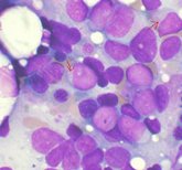 Foto: Logran un nanoconjugado dirigido a las células neoplásicas que bloquea la diseminación de la leucemia mieloide aguda