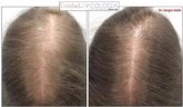 Foto: Un estudio confirma la eficacia de la terapia minoxidil oral en la alopecia androgénica