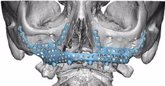 Foto: El Hospital La Luz ofrece la posibilidad de implantar una prótesis de titanio en el hueso maxilar superior