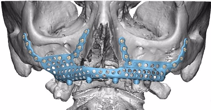 El Hospital La Luz ofrece la posibilidad de implantar una prótesis de titanio en el hueso maxilar superior