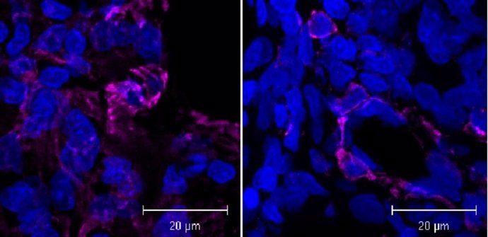 A la izquierda, células pulmonares tratadas con bleomicina con marcadores de fibrosis en rosa. A la derecha, la inoculación de nanopartículas con GSE4 produce una reducción significativa de la fibrosis.