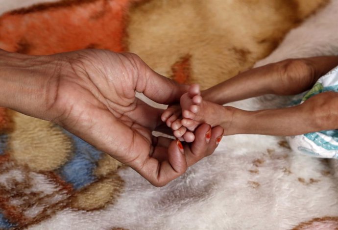 Archivo - Niño con desnutricion en un hospital de Saná, Yemen