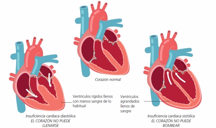 Insuficiencia cardiaca