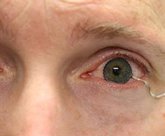 Foto: Prueban lentes de contacto blandas para tratar y controlar enfermedades oculares