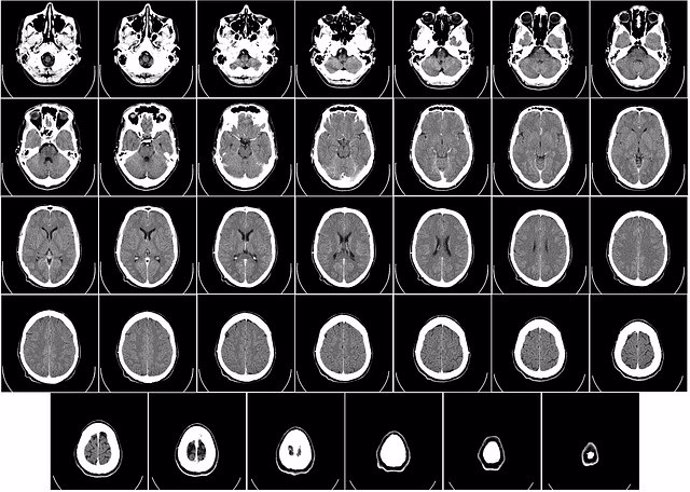 Archivo - Tomografía Computerizada Ct Radiografía Cerebro.