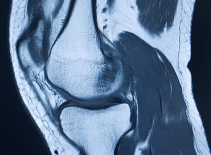 Archivo - Imagen médica de articulación de rodilla.