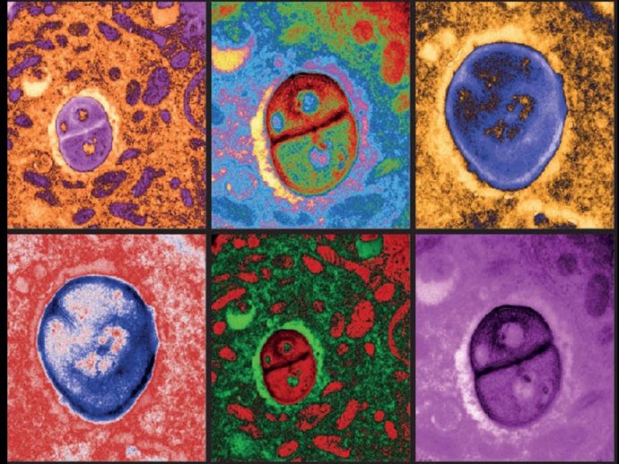 Imágenes de microscopía electrónica coloreadas digitalmente de células de melanoma que albergan bacterias
