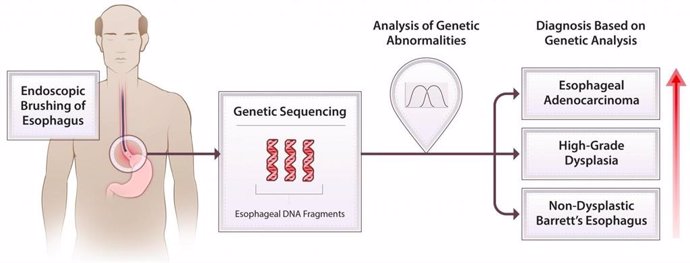 Una combinación de cepillado esofágico y secuenciación genética extensa de la muestra recolectada puede detectar alteraciones cromosómicas en personas con esófago de Barrett, identificando pacientes en riesgo de progresar a cáncer de esófago