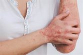 Foto: ¿Cuál es la relación entre psoriasis y enfermedad cardiovascular?