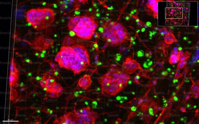 Archivo - Esferoides cancerosos elaborados a partir de cultivos triples que incluyen células de cáncer de ovario, células endoteliales y células madre mesenquimales que crecen dentro del material de coensamblaje péptido-proteína.