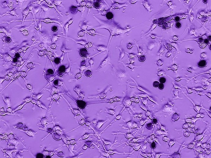 Archivo - Células de glioblastoma de un cerebro humano están creciendo. La adición del virus oncolítico Ebola-VSV produce infección tumoral y muerte celular, vista aquí como células negras. Con el tiempo, la infección se propaga a otras células de gliob