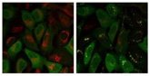 Foto: El Parkinson, el cáncer y la diabetes de tipo 2 comparten un elemento clave que impulsa la enfermedad