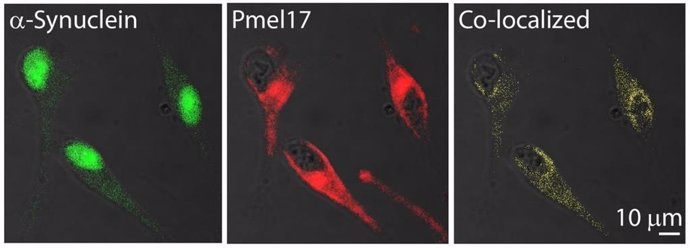 Imágenes de inmunofluorescencia muestran que parte de la a-sinucleína y Pmel17 se encuentran en las mismas localizaciones en las células de melanoma humano.