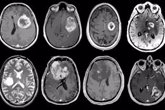 Foto: Descubren una terapia combinada que podría mejorar la supervivencia de los pacientes con tumores cerebrales agresivos