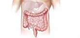 Foto: La respuesta inmunitaria del intestino contra la COVID-19 no proporciona protección a otros órganos