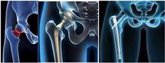 Foto: La cirugía precoz, clave en las fracturas de cadera
