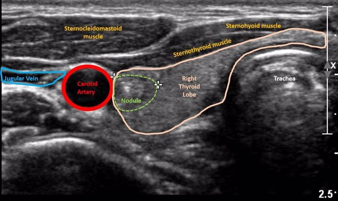 Archivo - Imagen de ultrasonido del nódulo tiroideo.