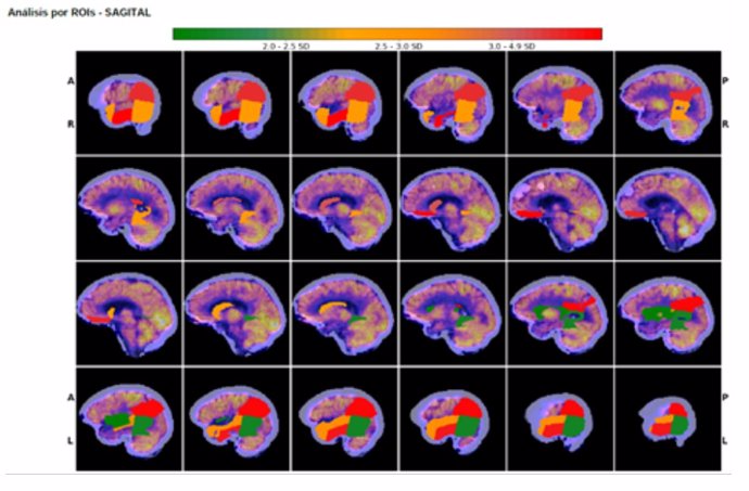 La Salud realiza de forma sistemática estudios cerebrales cuantificados capaces de valorar la evolución de la demencia