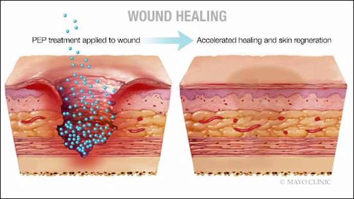 Investigadores consiguen sanar con piel sin cicatrices heridas crónicas de difícil tratamiento