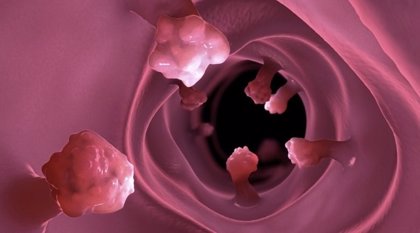 Los pólipos intestinales en familiares cercanos pueden aumentar el riesgo de cáncer colorrectal Los pólipos intestinales en familiares cercanos pueden aumentar el riesgo de cáncer colorrectal