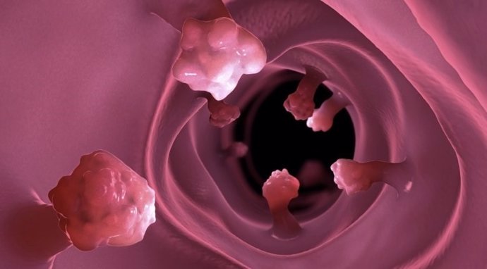 Ilustración de los pólipos intestinales que pueden causar cáncer colorrectal