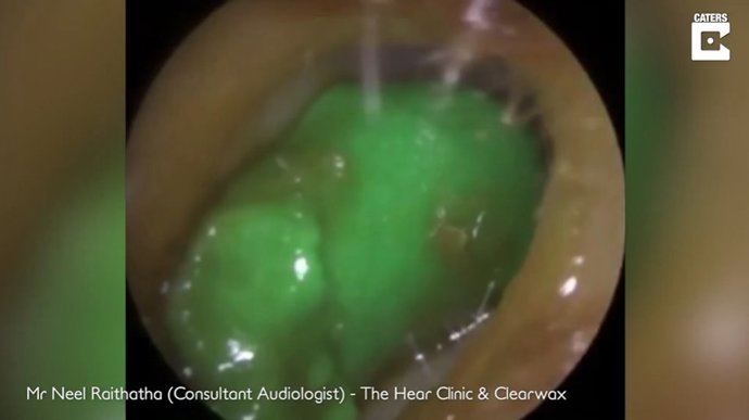 Este audiólogo retira plastilina del oído de un niño