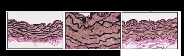 Imágenes de secciones de la arteria aorta de ratones mostrando que la desintegración de las fibras elásticas (líneas negras) y el engrosamiento de la pared vascular en los ratones Marfan es revertida por el silenciamiento génico de la proteína Prkg1