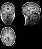 Foto: La COVID-19 altera el volumen de materia gris en el cerebro