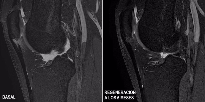 El Instituto De Terapia Regenerativa Tisular (ITRT) Ha Demostrado En Un Ensayo Clínico Que Las Células Madre Mesenquimales Cultivadas (CMMC), Obtenidas De Médula Ósea Del Propio Paciente, Tienen Capacidad Para Regenerar El Tendón.