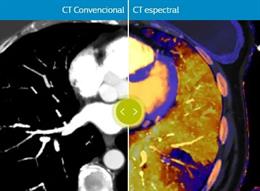 Diferencias entre una CT convencional y una CT espectral