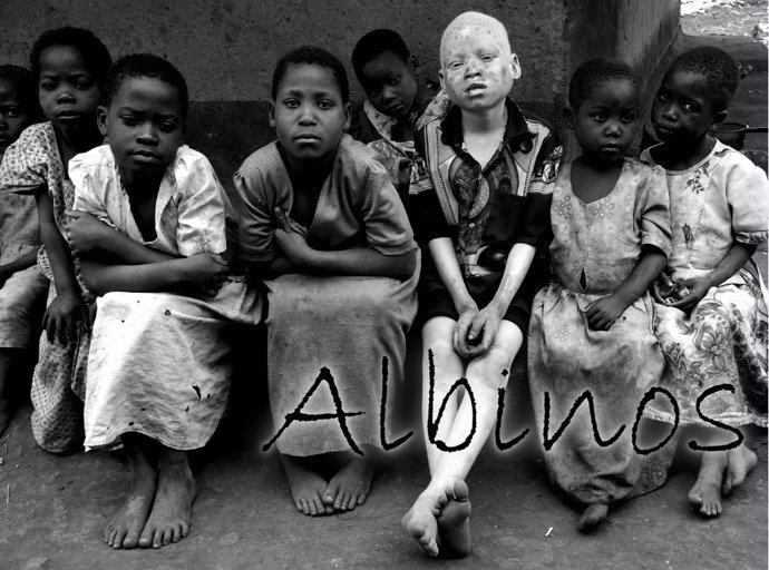 Archivo - Niños albinos en África