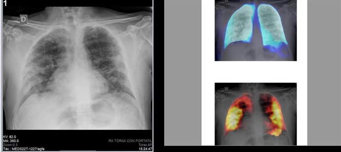 Técnicas de Inteligencia Artificial en radiografías de tórax