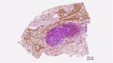 Foto: Un nuevo tratamiento contra el cáncer de páncreas frena el crecimiento tumoral en ratones