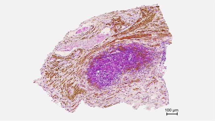 Archivo - Imagen de anatomía patológica que muestra la biodistribución de las nanopartículas magnéticas (de color marrón) en el tumor.