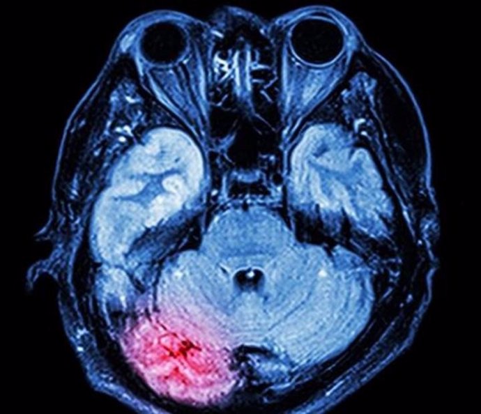 La zona roja muestra el lugar donde se inflama el cerebro después de una conmoción cerebral.
