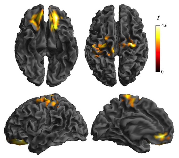 Alteración de la conectividad en la corteza orbitofrontal y somatosensorial