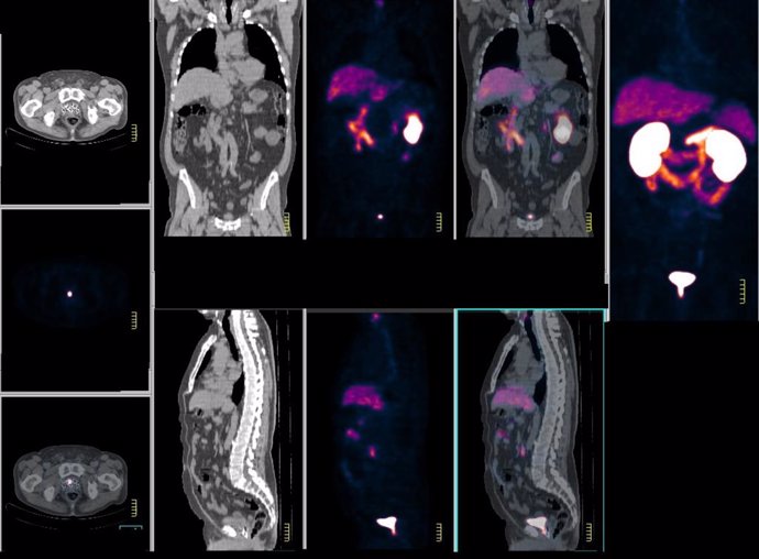 Archivo - PET-TAC con PSMA es una terapia efectiva en la detección y manejo del cáncer de próstata