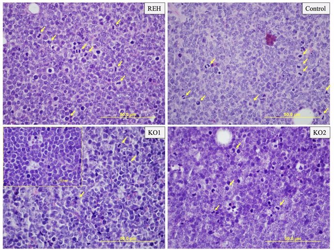 Archivo - Leucemia aguda linfoblástica