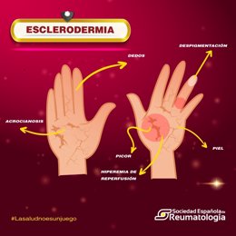La Sociedad Española de Reumatología se une a la celebración del Día Mundial de la Esclerodermia