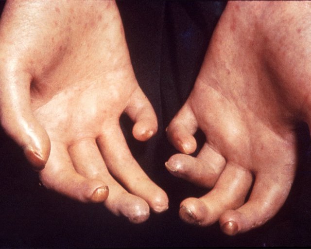 Archivo - Esclerodermia