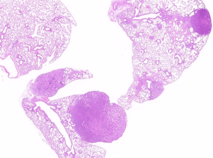 Tumor pulmonar inducido por KRAS4A.