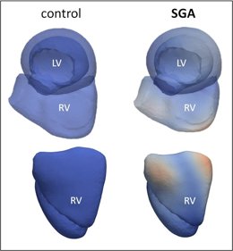 Reconstrucción del corazón a partir de imágenes de resonancia cardíaca. A la derecha, imagen del corazón de una persona adulta nacida con bajo peso. En rojo se indican las diferencias respecto el corazón de una persona adulta que nació con peso normal.