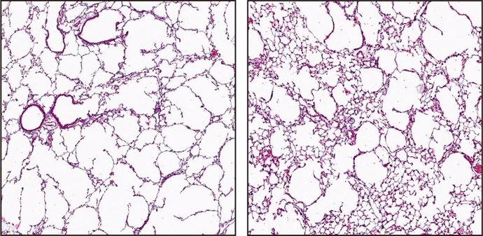 La inyección de células endoteliales pulmonares sanas (derecha) revierte la destrucción de tejido pulmonar observada en ratones con enfisema (izquierda).